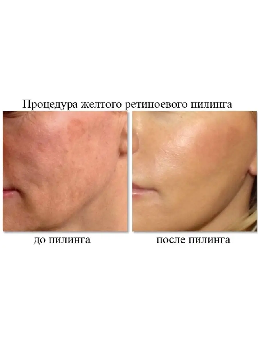 Желтый пилинг Block Age Peel Gel на 1 процедуру Medic Control Peel 72383531  купить за 2 916 ₽ в интернет-магазине Wildberries