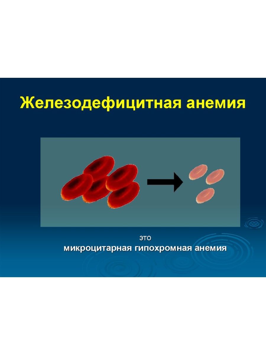 Железо дефицитная анемия. Железнодефецитная Анимия. Патогенез железодефицитной анемии. Железодефицитная анемия этиология. Этиология жда.